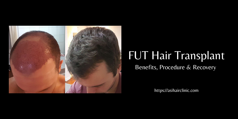 FUT Hair Transplant: Benefits, Procedure & Recovery