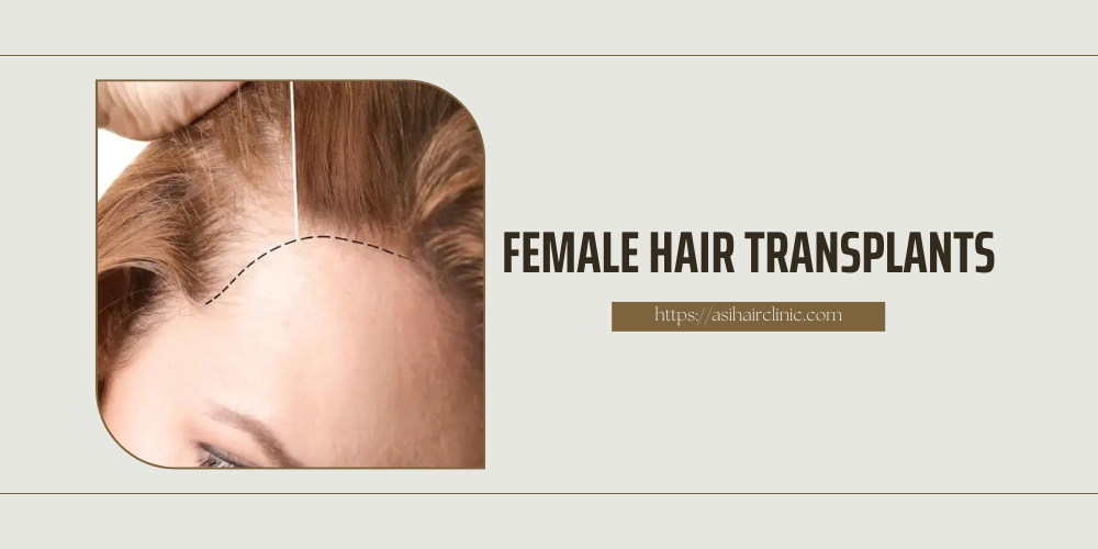 Female Hair Transplants: All You Need to Know