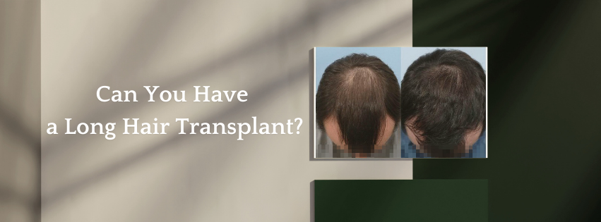 Can You Have a Long Hair Transplant?