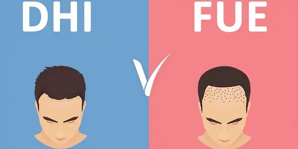 What's the Difference Between FUE and DHI Hair Transplant?