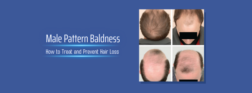 Male Pattern Baldness: How to Treat and Prevent Hair Loss