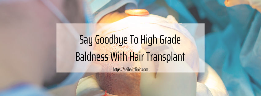 Say Goodbye To High Grade Baldness With Hair Transplant