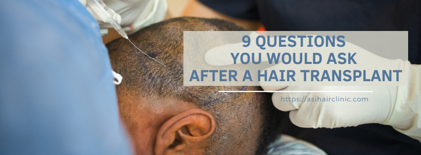 9 Questions You Would Ask After A Hair Transplant