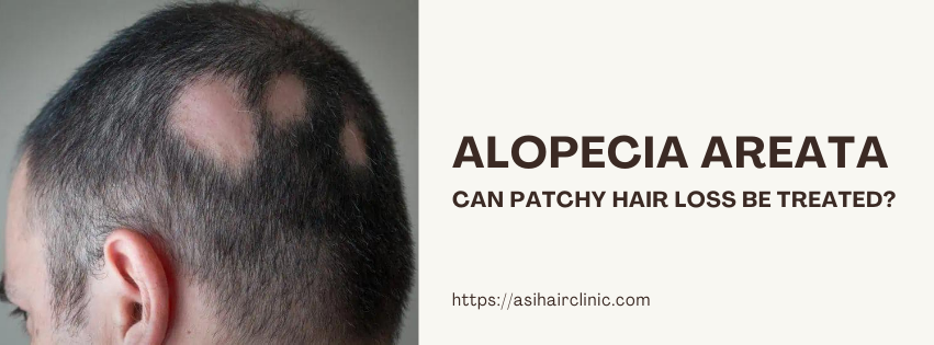 Alopecia Areata: Can Patchy Hair Loss Be Treated?