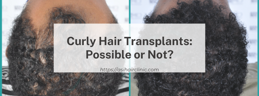 Curly Hair Transplants: Possible or Not?