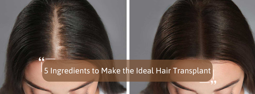 5 Ingredients to Make the Ideal Hair Transplant