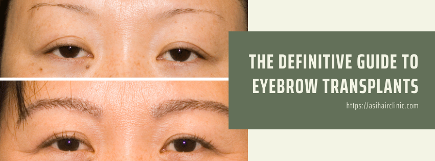 The Definitive Guide to Eyebrow Transplants