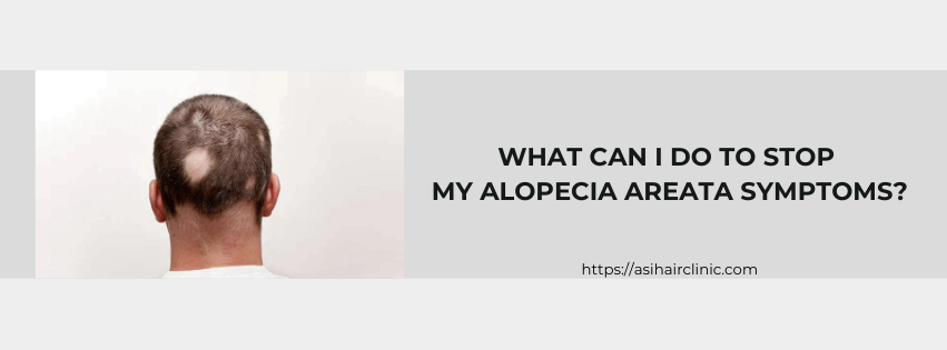 What Can I Do To Stop My Alopecia Areata Symptoms?