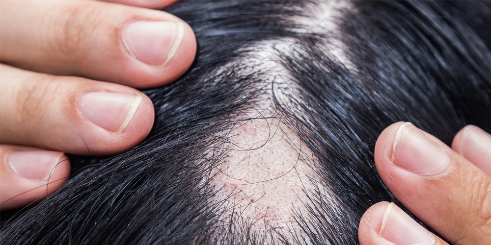 Anemia Hair Loss Signs Symptoms And Remedies