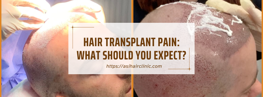 Hair Transplant Pain: What Should You Expect?