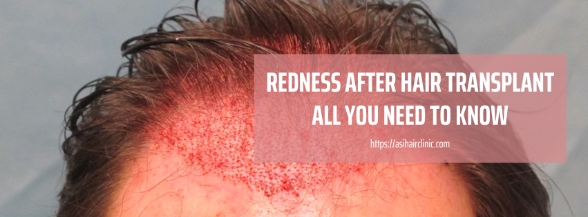 Redness After Hair Transplant: All You Need To Know