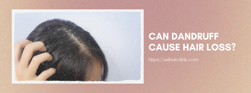 Can Dandruff Cause Hair Loss?