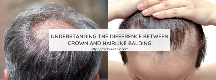 Understanding the Difference Between Crown and Hairline Balding