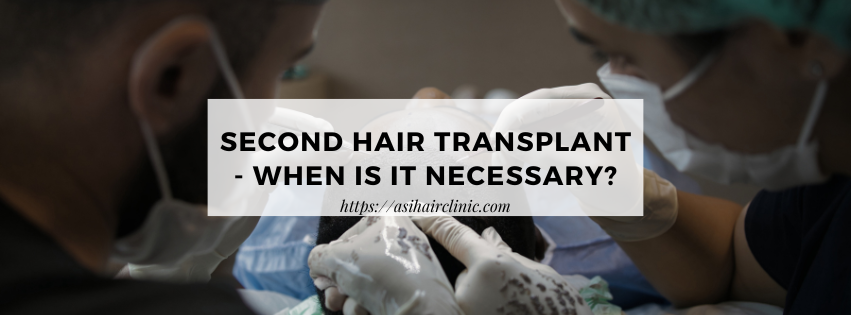 Second Hair Transplant - When Is It Necessary?