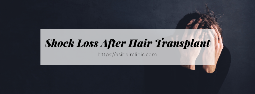 Shock Loss After Hair Transplant