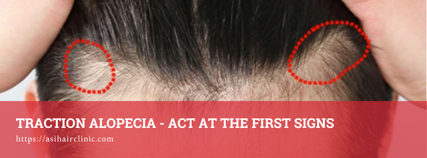 Traction Alopecia – Act at the First Signs