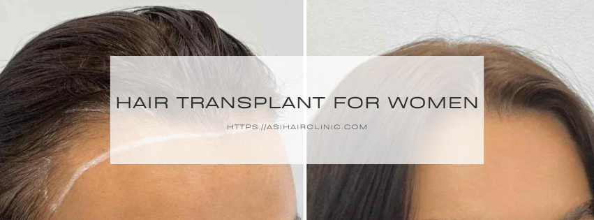 Hair Transplant for Women: Facts, Surgery & Aftercare