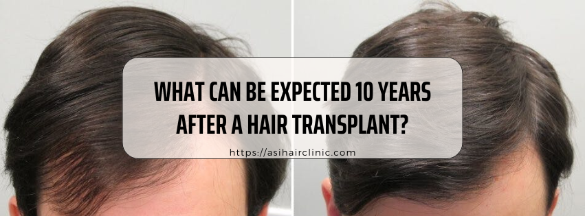 What Can Be Expected 10 Years After A Hair Transplant?