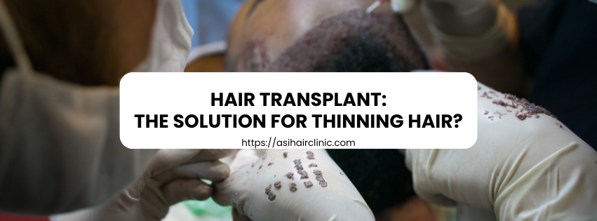 Hair transplant: the solution for thinning hair?