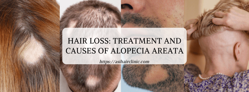 Hair loss: Treatment and causes of alopecia areata