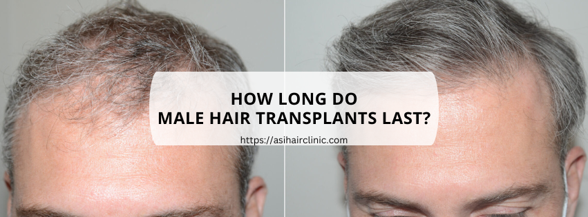 How long do male hair transplants last?