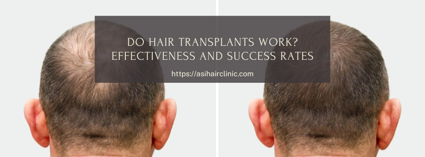 Do Hair Transplants Work? Effectiveness and Success Rates