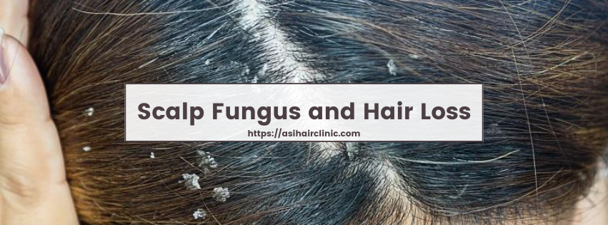 Scalp Fungus and Hair Loss