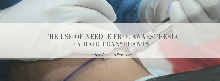 The Use of Needle Free Anaesthesia in Hair Transplants