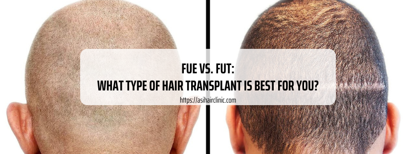 FUE vs. FUT: What Type Of Hair Transplant Is Best For You?