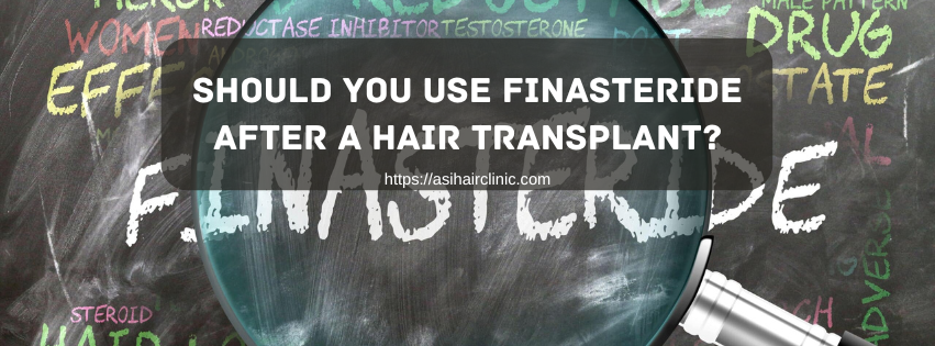 Should You Use Finasteride After a Hair Transplant?