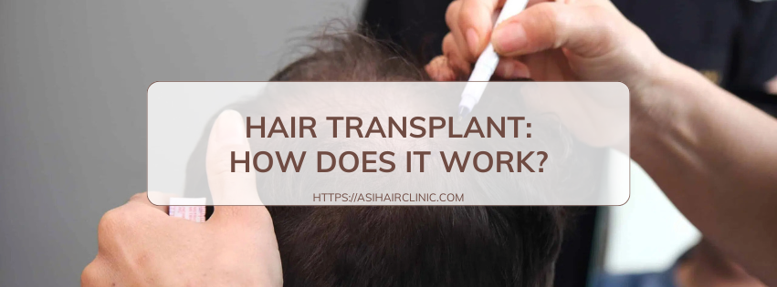 Hair transplant: How does it work?