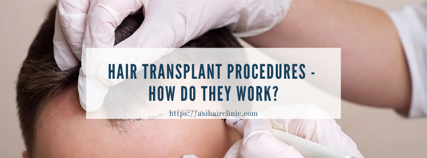 Hair Transplant Procedures - How Do They Work?