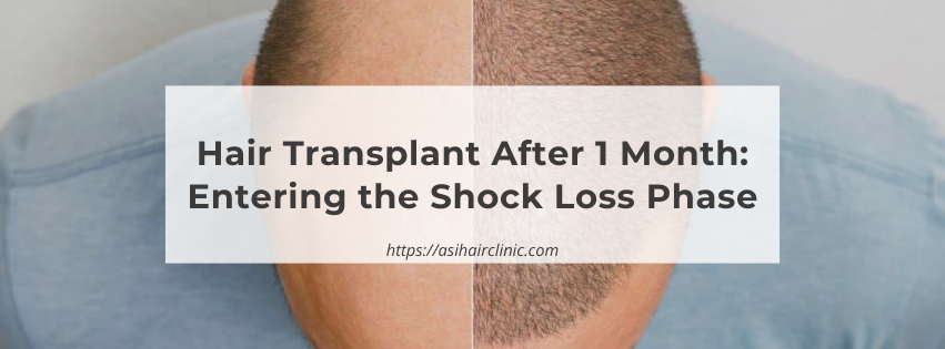 Hair Transplant After 1 Month: Entering the Shock Loss Phase