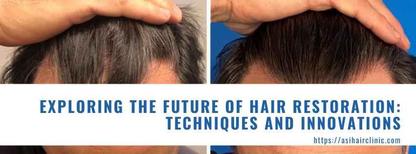 Exploring the Future of Hair Restoration: Techniques and Innovations