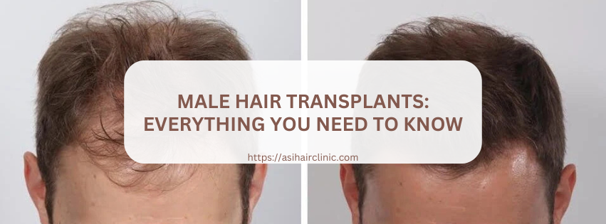 Male Hair Transplants: Everything You Need to Know