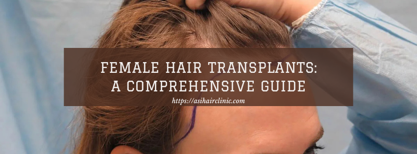 Female Hair Transplants: A Comprehensive Guide