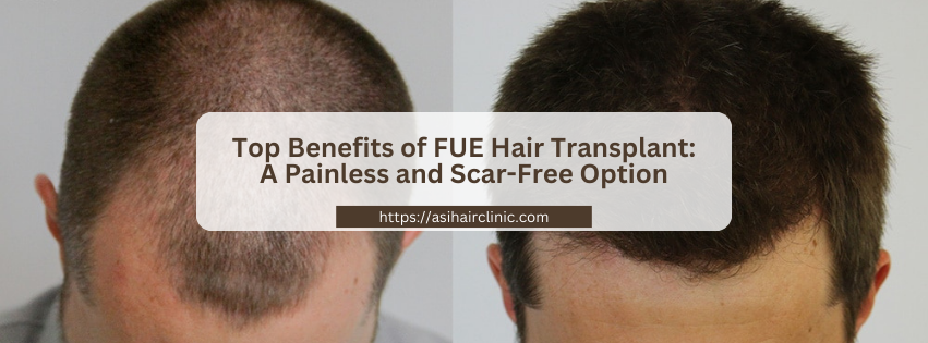 Top Benefits of FUE Hair Transplant: A Painless and Scar-Free Option