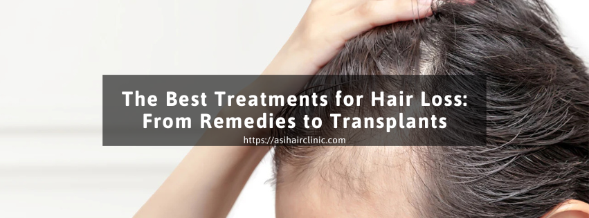 The Best Treatments for Hair Loss: From Remedies to Transplants