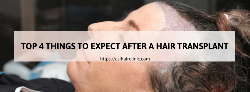 Top 4 Things to Expect After a Hair Transplant