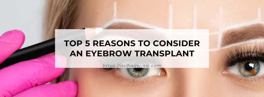 Top 5 Reasons to Consider an Eyebrow Transplant