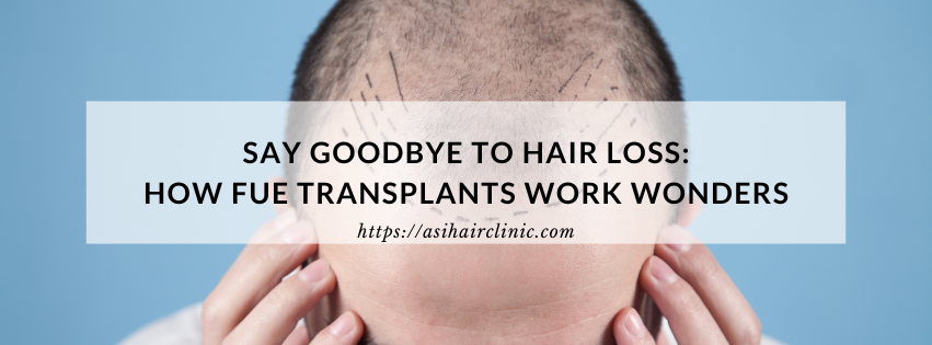 Say Goodbye to Hair Loss: How FUE Transplants Work Wonders