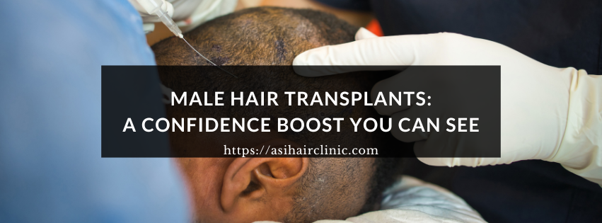 Male Hair Transplants: A Confidence Boost You Can See