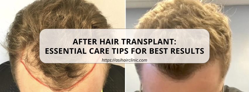 After Hair Transplant: Essential Care Tips for Best Results