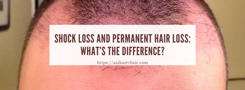 Shock Loss and Permanent Hair Loss: What’s the Difference?