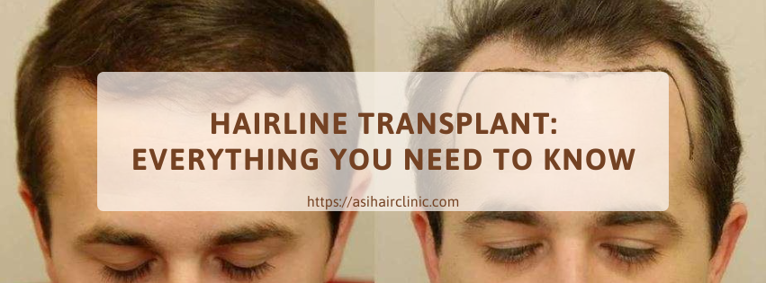 Hairline Transplant: Everything You Need to Know