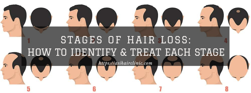 Stages of Hair Loss: How to Identify & Treat Each Stage