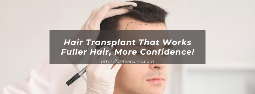 Hair Transplant That Works - Fuller Hair, More Confidence!