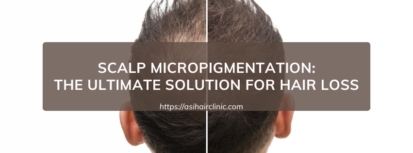 Scalp Micropigmentation: The Ultimate Solution for Hair Loss