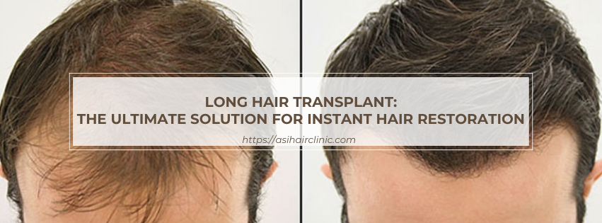 Long Hair Transplant: The Ultimate Solution for Instant Hair Restoration