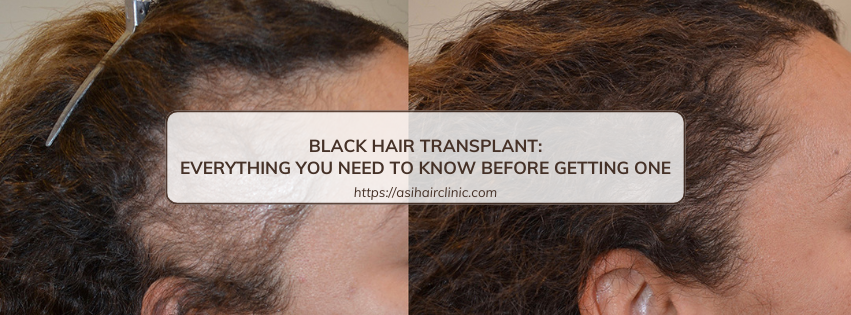 Black Hair Transplant: Everything You Need to Know Before Getting One